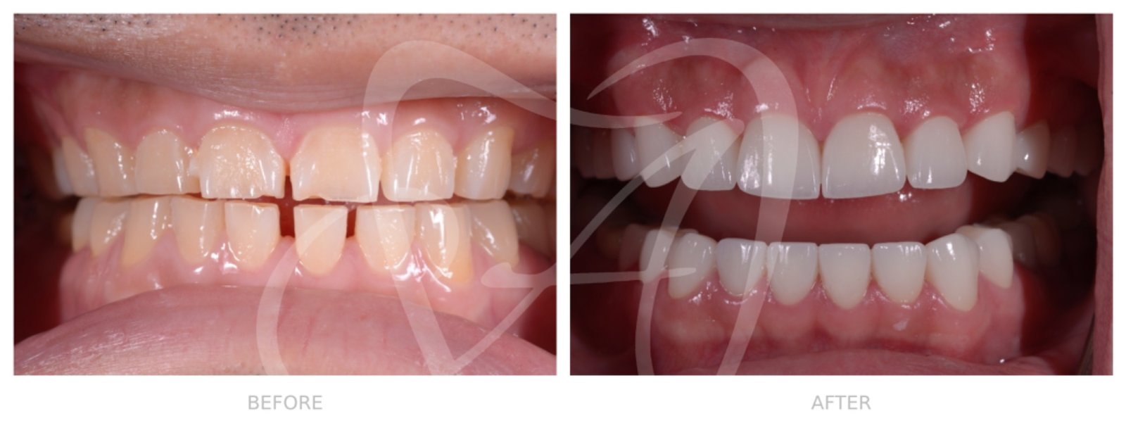 Before and After Dental Transformation 4