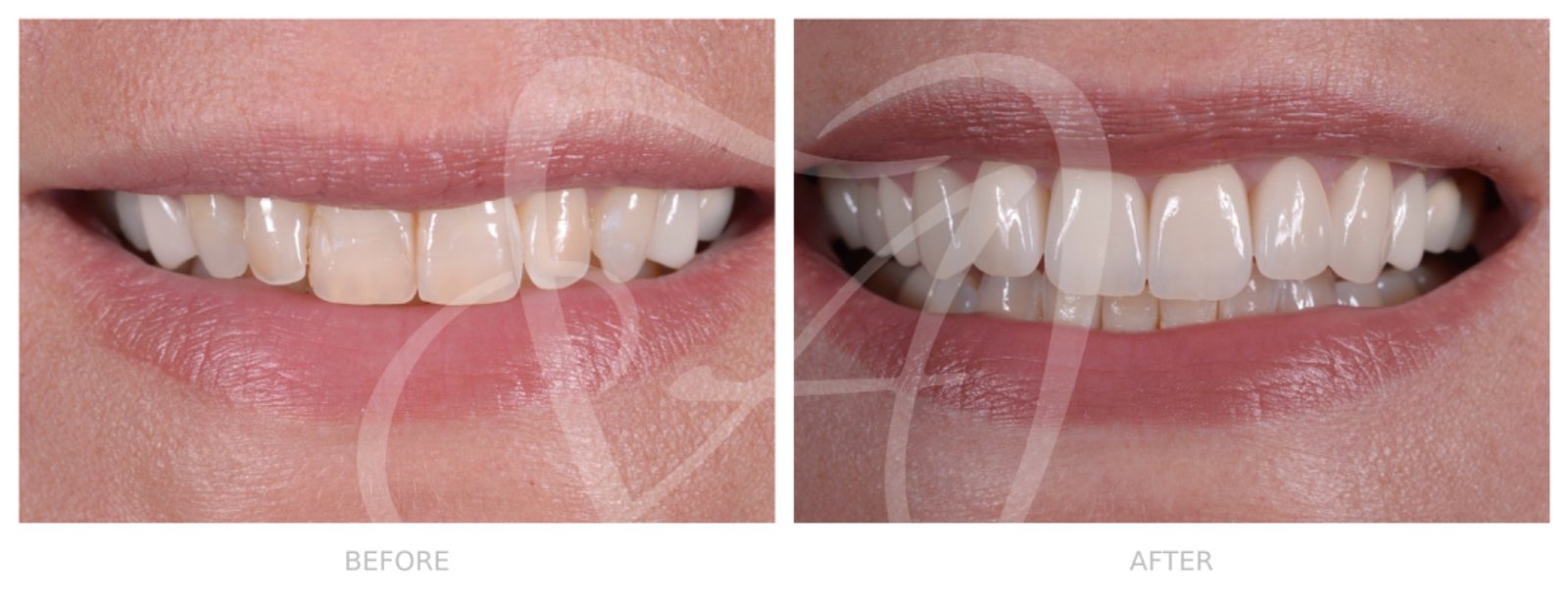 Before and After Dental Transformation 5